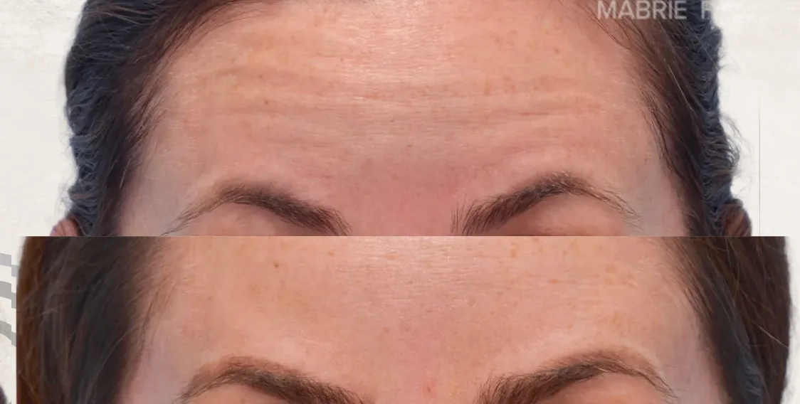 Botox Frente